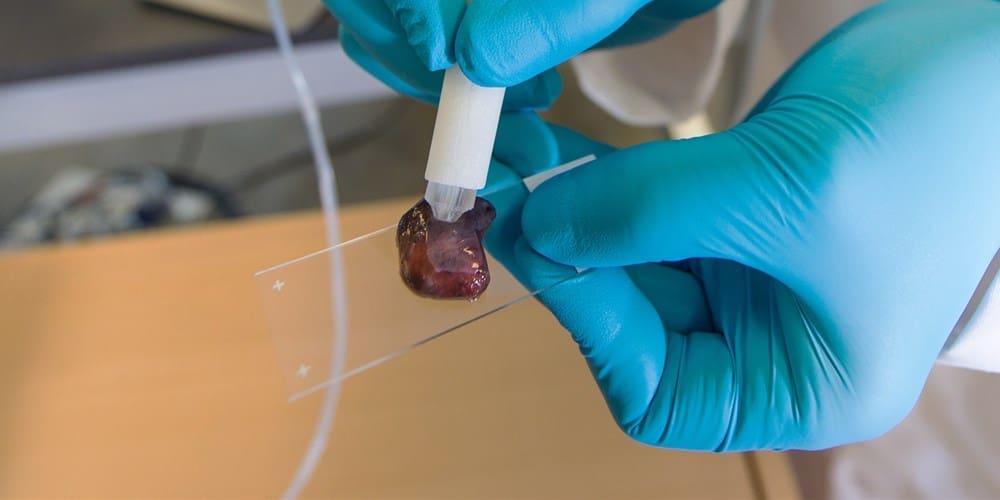 The MasSpec pen can detect cancerous tissue in an instant (photo fromVivian Abagiu / Univ. of Texas at Austin