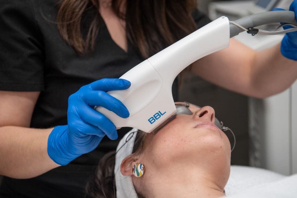 BBL treats age spots, sun damage, redness, broken facial vessels, wrinkles and dull skin.