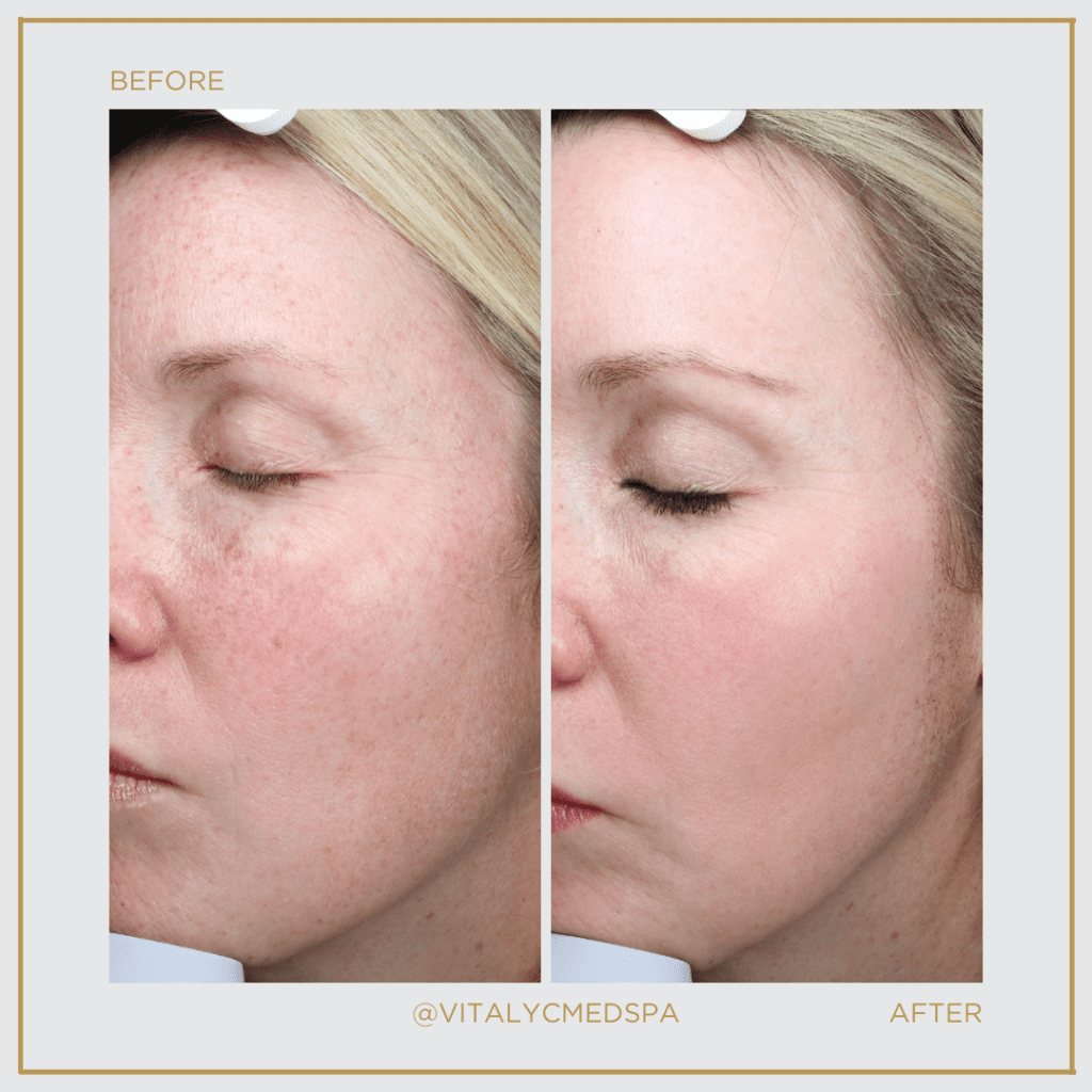 Before + After a BBL/Halo combo treatment at Vitalyc Med Spa.