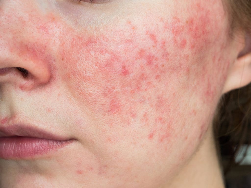 Dr. Jennifer Cather, a board-certified dermatologist, as well as Chief Medical Officer and founder of Mindful Dermatology and Modern Research Associates tells PaperCity what triggers rosacea.